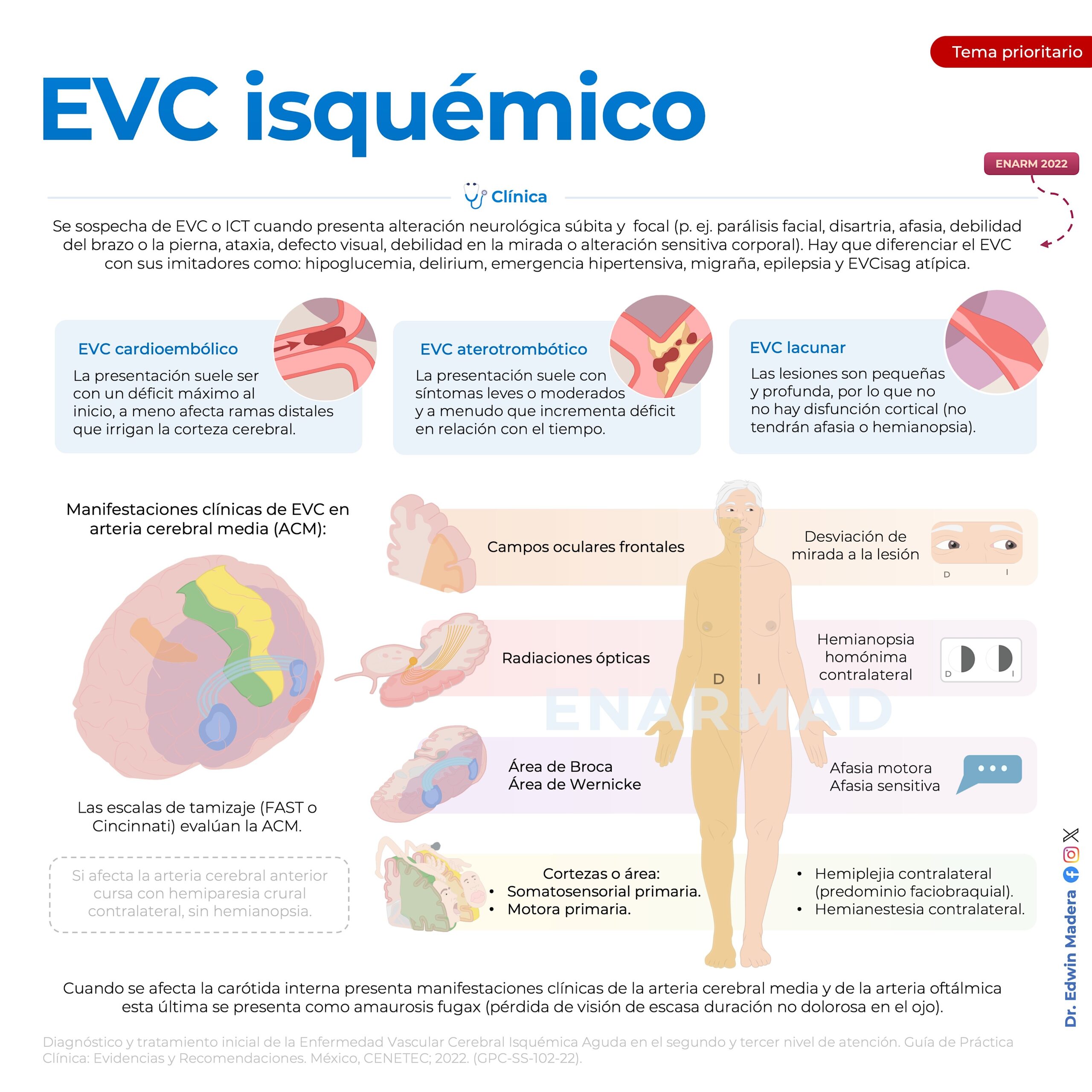 EVC isquémica 3